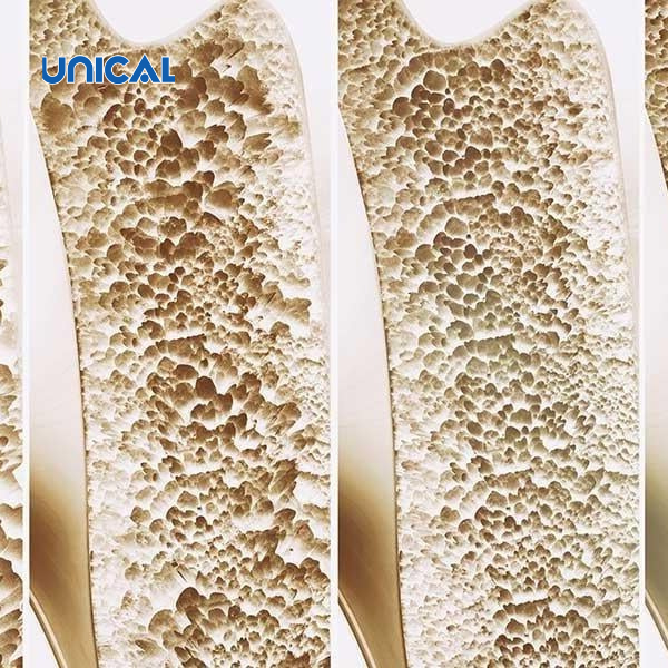 Canxi unical giúp giảm loãng xương ở người cao tuổi