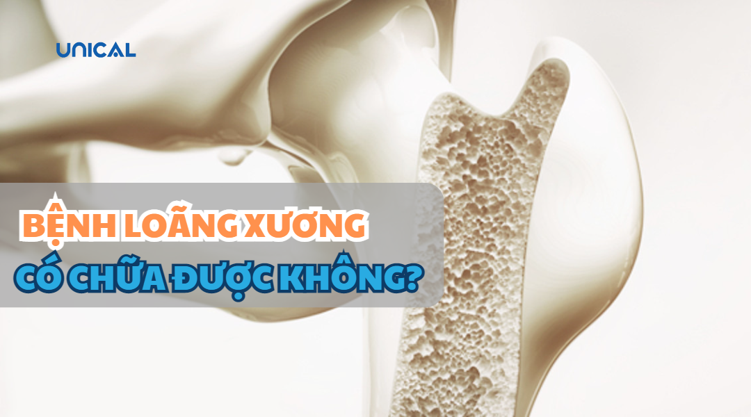 BỆNH LOÃNG XƯƠNG CÓ CHỮA ĐƯỢC KHÔNG