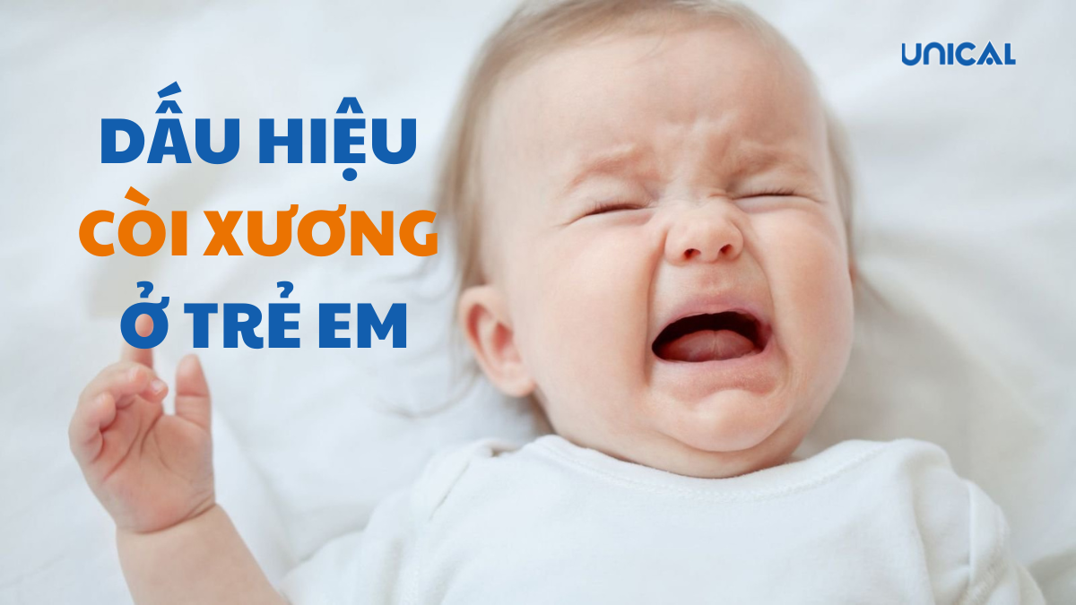 Dấu hiệu trẻ bị còi xương