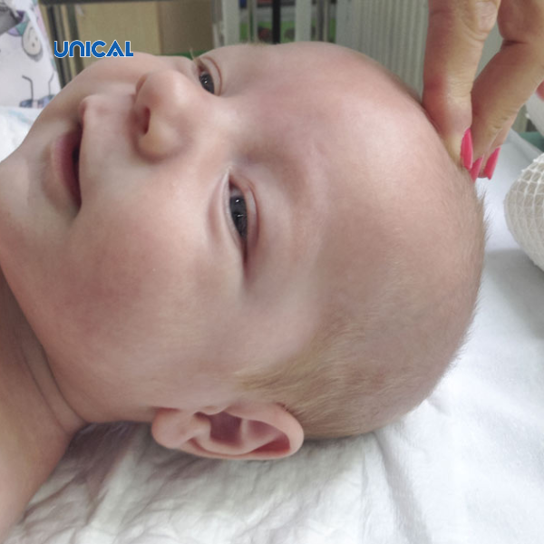Thóp liền chậm do còi xương